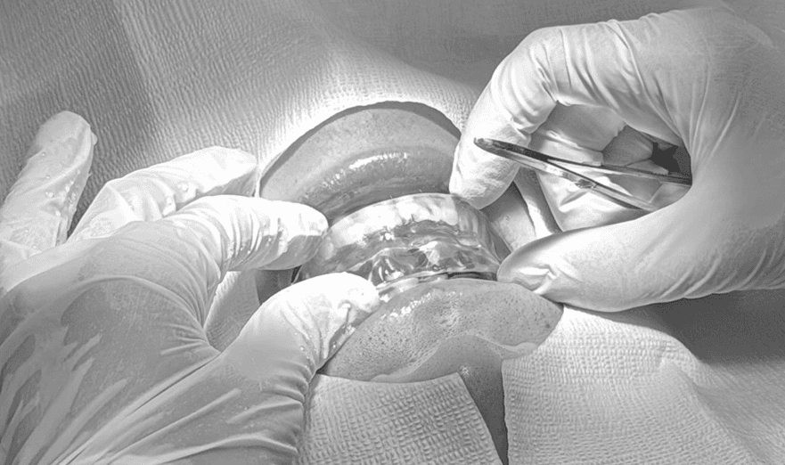 이갈이 / 이악물기 치료