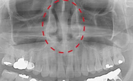 비강 내 염증 개선