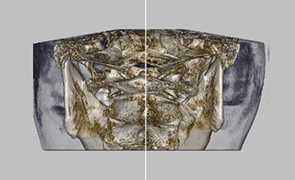 틀어진 턱관절 개선